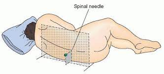 Only inject about 1 ml! Lumbar Puncture And Cerebrospinal Fluid Analysis Neupsy Key