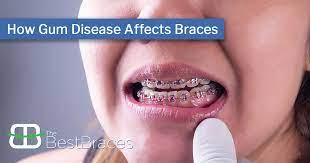 Cold temperatures can reduce inflammation and numb the mouth so you don't feel the pain. How Gum Disease Affects Braces The Best Braces Orthodontists In Southfield Mi
