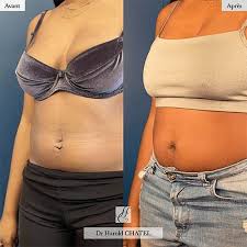 L'abdominoplastie est l'intervention de chirurgie plastique la plus fréquemment pratiquée, juste après la réduction mammaire. Plastie Du Nombril Ombilicoplastie Docteur Harold Chatel