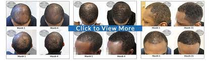 This medication works by inhibiting an enzyme that leads to hair loss, she notes. Do Your Hair Loss Treatments Work On Black Men
