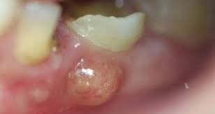 Gusi bengkak juga dikenali sebagai gingivitis. Masalah Gusi Bernanah Klinik Pergigian Dr Smile Facebook
