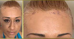 The disease completely destroys hairs, leaving female lice lay eggs and attach them to the base of hair shafts, near the surface of the scalp (37). Chemical Burns From Hair Color Cranial Prosthesis