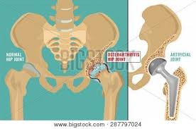 1.4 back anatomy spine (erector spinae (lower back anatomy)). Hip Osteoarthritis Vector Photo Free Trial Bigstock