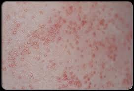 Common Symptoms Of Heat Rash Are Red Bumps On The Skin And An Itchy Or Prickly Feeling To The Skin Usu Occur In Areas Whic Heat Rash Itchy Rash Prickly Heat