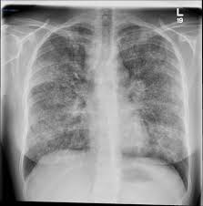 Sarcoidosis There Is A Widespread Predominantly Reticulonodular Pattern With Relative Sparing Of The Lung Bases Ther Radiology Radiology Imaging Pulmonology