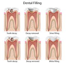 The treatment should be done immediately. Dental Filling Procedure