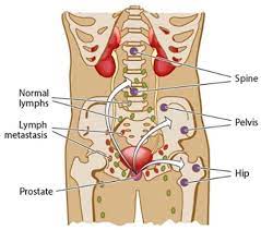 Additionally, we evaluated the distribution of metastatic sites amongst patients with and without bone metastases. Advanced And Metastatic Prostate Cancer What Is It Pcfa