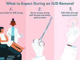 To avoid possible complications, bayer doesn't recommend women remove their own mirena. What To Expect During Your Iud Removal