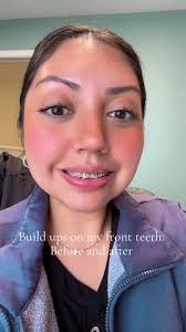 Erica Pineda Teeth Before and After