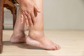 What Causes Leg Numbness? | American Endovascular