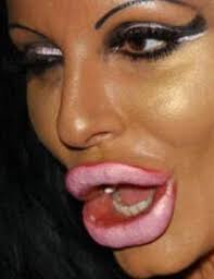 Pin By Mark On Ch Thra Bad Lip Injections Lip Injections Plastic Surgery Fail