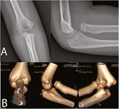 Image result for Radial Head Dislocation