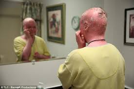 These birth defects are called neural tube defects or ntds. Harlequin Ichthyosis Sufferer Says People Ask Me If I Ve Been In A Fire Daily Mail Online
