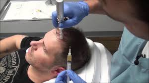 Pretty much what happens is your hair is color matched and the directional patterns on your scalp are duplicated. Hair Club For Men Galhairs