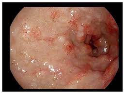 Gastrointestinal Manifestations Of Hereditary Hemorrhagic Telangiectasia Hht A Systematic Review Of The Literature Abstract Europe Pmc
