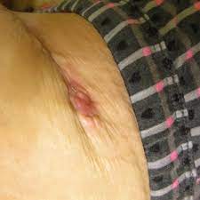 Many doctors remove granulomas with curettage and cauterization. How To Treat Spitting Sutures And Or Suture Granuloma When You Cant Get Back To The Surgeon Photo