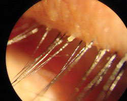 Ocular mites, look identical to scalp mites. Demodex Infestation Requires Immediate Aggressive Treatment By Doctor Patient