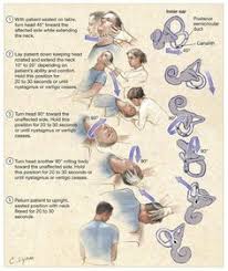 Repeat this daily until free from positional vertigo for 24 hours. 11 Epley Maneuver Ideas Epley Maneuver Vertigo Exercises Vertigo Treatment