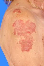 Maybe you would like to learn more about one of these? Autoimmunkrankheiten Umm Universitatsmedizin Mannheim