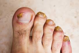 It may initially appear as a white or yellow those with sensitive skin must do a skin patch test before using garlic. Nurses Know That Home Remedies Knock Out Nasty Nail Fungus The People S Pharmacy
