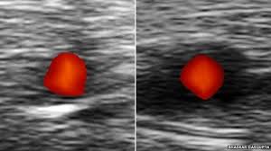 Arteritis De Celulas Gigantes Como Detectar La Enfermedad Que Provoca Ceguera En Unas Pocas Horas Bbc News Mundo