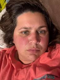 Does lupus cause panting breathing problem sometimes and extreme fatigue?