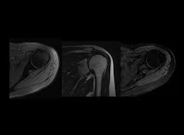 However, there are also alternatives such as ultrasound, which can also confirm rotator cuff tears. Mri Scan Dubai Radiology Center Same Day Mri
