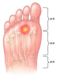 Check spelling or type a new query. Foot Pain Map What Are The Signs Of Pain In Different Parts Of The Sole Of The Foot Inews