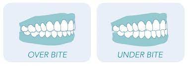 Overbite correction for kids and teenagers. Everything You Need To Know About Overbites And Underbites