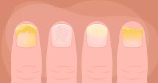 Image result for Nail Pitting