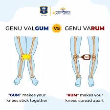 Image result for Genu Varum