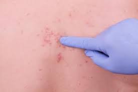 Up to 90% of people in the u.s. Pin On Remedies For Herpes