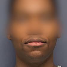 Waist narrowing (aka Rib Removal) results: This fabulous (and fit💪🏻)  patient achieved a really outstanding result. Scroll to have a look, and  see the minimal incision in the last photo. She was