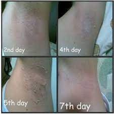 Natural remedies for underarms hair removal. Bleach Armpits