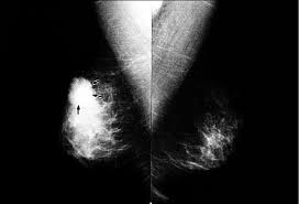 Rarely, a rash and soreness can be signs. Inflammatory Breast Cancer In A 40 Year Old Woman With A Palpable Mass Download Scientific Diagram
