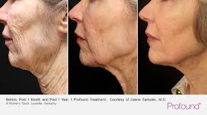 We had to re-share this fabulous result from Julene B. Samuels, MD  Aesthetic Plastic Surgeon using the #Profound System to seemingly turn the  clock back for her patient. The images here represent