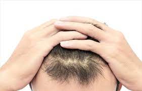 mevsim degisiklikleri ve metabolizma hizi sac dokulmesinde etkili