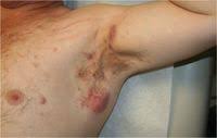 Have you ever wondered if laser hair removal is actually effective for hs? Laser Assisted Hair Removal Procedure Beneficial For Treatment Of Hidradenitis Suppurativa
