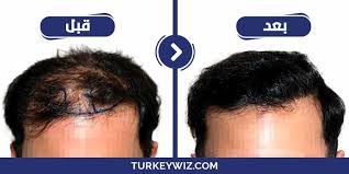 زراعة الشعر كم التكلفة وماهي الخطوات والمخاطر المحتملة قبل وبعد العملية تركي ويز