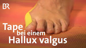Was Tun Beim Ballenzeh Tape Bei Einem Hallux Valgus Anleitung Fusspflege Ballen Youtube