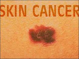 Skin cancer — the abnormal growth of skin cells — most often develops on skin exposed to the sun. Skin Cancer In Kids On The Rise Cbs News