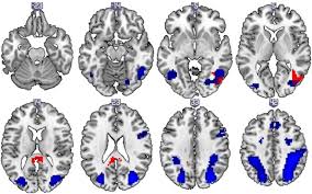 The latest tweets from @yeraldin__g_ Mir 137 Derived Polygenic Risk Effects On Cognitive Performance In Patients With Schizophrenia And Controls Translational Psychiatry