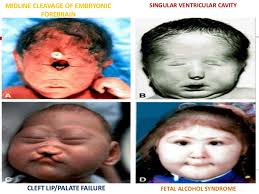 A person suffering form fetal alcohol syndrome was exposed to alcohol in utero, as the mother consumed alcoholic beverages without regard for the safety of the pregnancy. Fetal Alcohol Syndrome