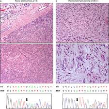 Image result for Leiomyosarcoma