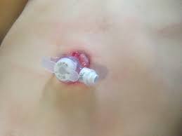 Staph Infection After Surgery Photos G Tube Removal