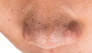 Existem várias formas naturais e caseiras de remover cravos do rosto como fazer uma máscara com gelatina e leite ou utilizar um esfoliante de aveia ou açúcar, por exemplo. O Que Sao Cravos Tipos Causas E Como Tirar Do Nariz E Do Rosto