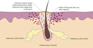 Image result for Pustule