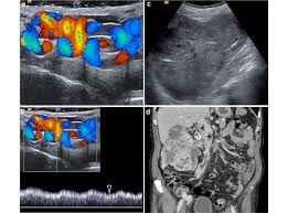 Image result for Varicocele