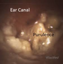 Image result for Acute Otitis Externa