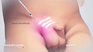 Image result for Inguinal hernia man